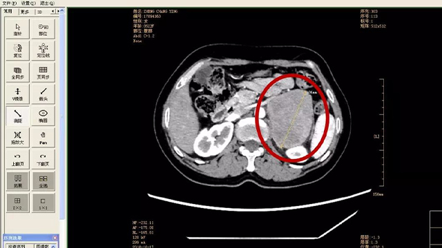 嗜铬细胞瘤影像图