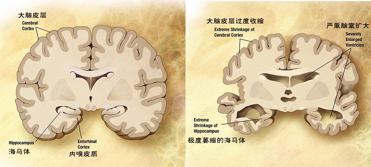 Alzheimer's_disease_brain_comparison脑比较